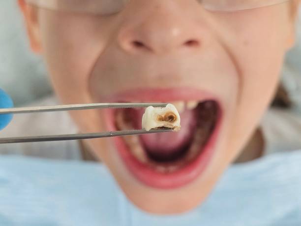 Best Dental Abscess Treatment in Atkins, VA